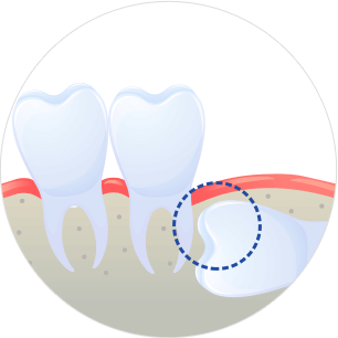사랑니가 겉으로 보이지 않는 경우