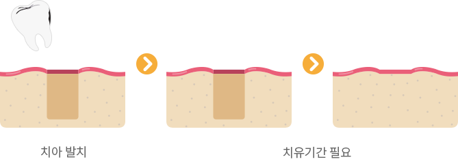 일반 임플란트의 진행 과정