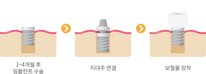 일반 임플란트의 진행 과정