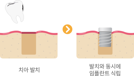 당일 즉시 임플란트의 진행 과정