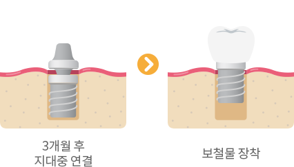 당일 즉시 임플란트의 진행 과정